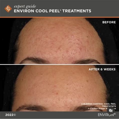 SIX Peel Treatments .